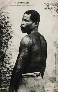 Le miraculé de la montagne Pelée, probable photographie de Louis-Auguste Cyparis.