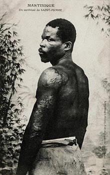 Le miraculé de la montagne Pelée, probable photographie de Louis-Auguste Cyparis.